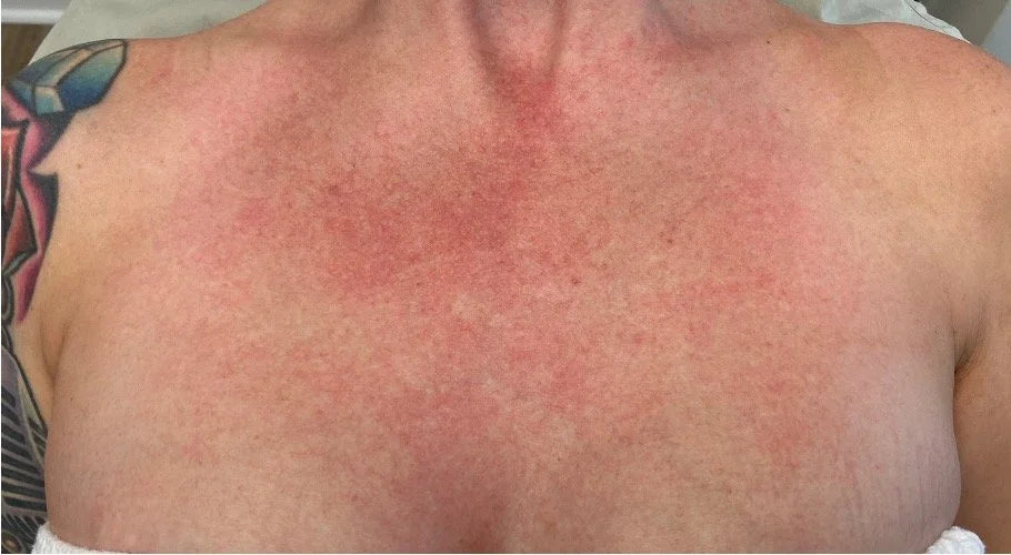 Persistent redness on the chest